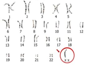sindrome-de-turner-que-es-y-como-detectarlo