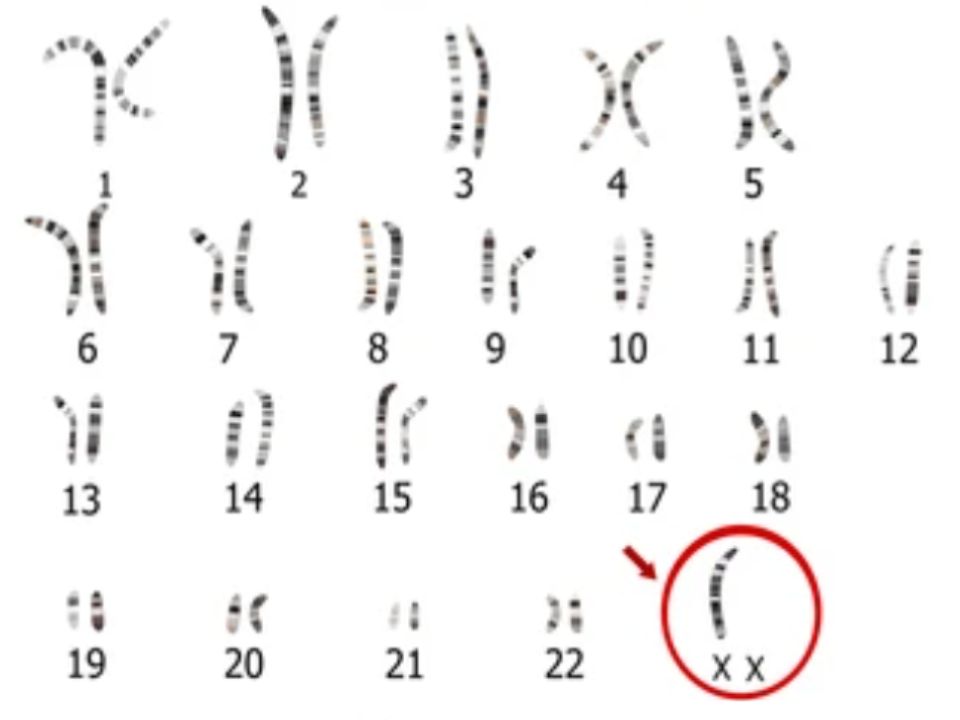 sindrome-de-turner-que-es-y-como-detectarlo