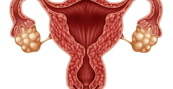 olycystic-ovary-syndrome-according-to-the-age-ovaries-with-pcos-polycystic-ovary-syndrome