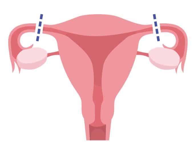 eliminacion-de-la-violencia-contra-la-mujer-ilustracion-salpingoclasia