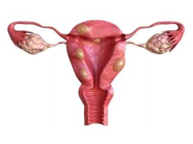 que-es-la-miomatosis-uterina-y-como-afecta-tu-fertilidad