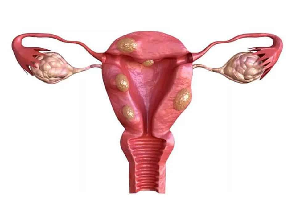 que-es-la-miomatosis-uterina-y-como-afecta-tu-fertilidad