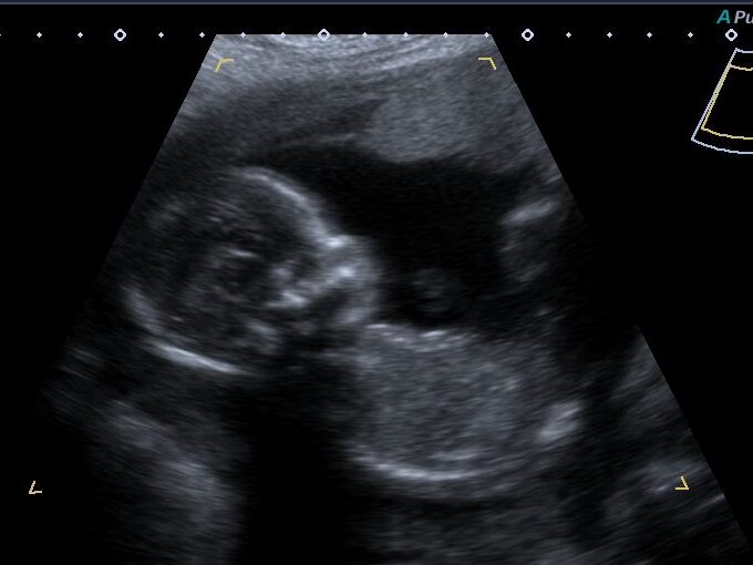 what-does-maternal-fetal-medicine-do-ecography