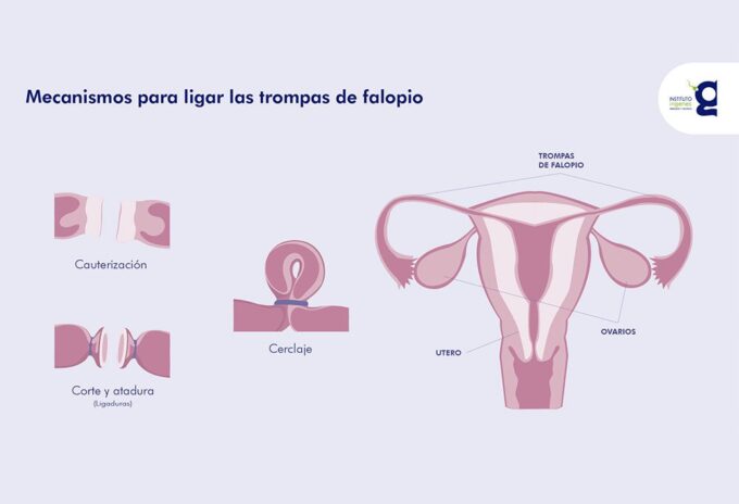 ligadura-de-trompas-salpingoclasia